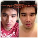 ร้อยไหมก้างปลาวีเชฟไม่จำกัดเส้น+โบท้อกกราม+สลายไขมัน4เข็ม14900