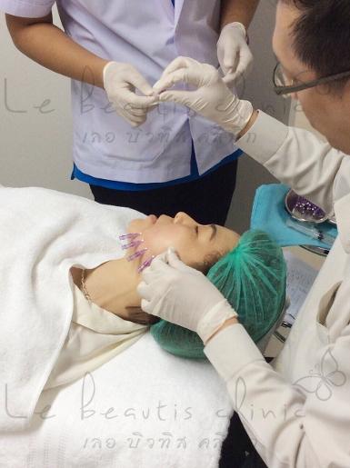ร้อยไหมหน้าวีเชฟแบบไม่จำกัดเส้นแถมโบท้อก50ยูนิตเพียง9900บาท-,0863710814