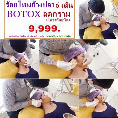 ร้อยไหมวีเชฟหน้าเรียวไม่จำกัดเส้นฟรีโบท้อกไม่จำกัดยูนิต 9900บาท ที่นารีญาคลีนิค090-9531414