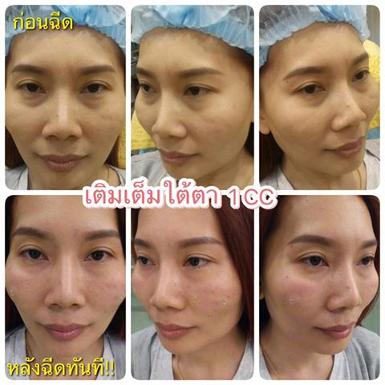 ฟิลเลอร์ใต้ตาคาง ร่องแก้มของแท้1cc 11900( Perfectha )