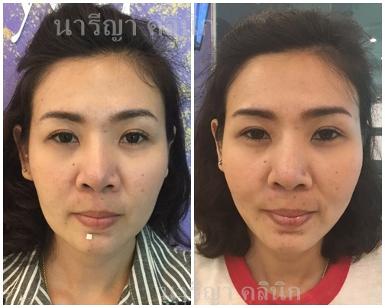 ร้อยไหมก้างปลาวีเชฟ6เส้น+โบท้อกกรามไม่จำกัดยูนิต 9900บาท